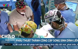 Phẫu thuật thành công cặp song sinh dính liền