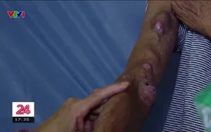 Hà Nội: Người dân xóm chạy thận chống chọi với cái rét