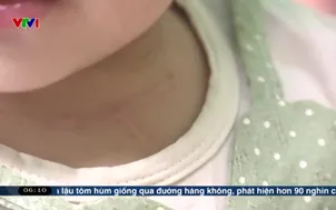 Ca mổ nối mạch bạch huyết chưa từng có