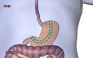 Tái tạo thực quản cho bệnh nhân ung thư bằng ống dạ dày 