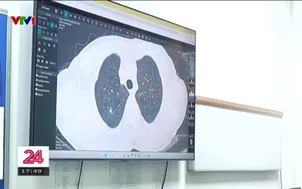 Phát hiện sớm giúp nâng cao hiệu quả điều trị ung thư phổi
