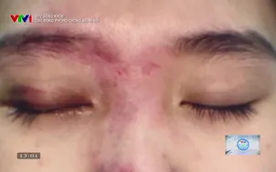 VTV Sống khỏe: Chủ động phòng chống bệnh Sởi