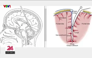 Phẫu thuật thành công cho bé gái bị động kinh hơn 4 năm