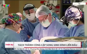 Tách thành công cặp song sinh dính liền đầu