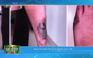 	VTV Sống khỏe: 	Nguy cơ ung thư da