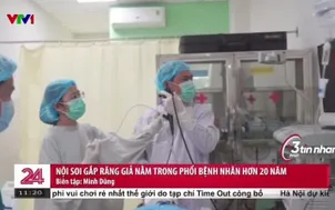 Nội soi gắp răng giả trong phổi bệnh nhân hơn 20 năm 