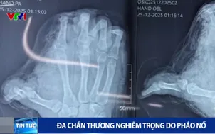 Đa chấn thương nghiêm trọng do pháo nổ