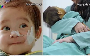 Ghép gan cho bệnh nhi 1 tuổi xơ gan giai đoạn cuối