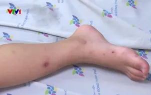 Giải pháp kiểm soát bệnh tay chân miệng