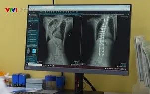 VTV Sống khỏe: Công nghệ 3D trong phẫu thuật cột sống