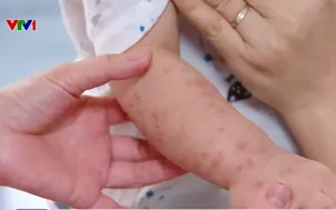 Nguy cơ lây lan bệnh tay chân miệng đầu năm học