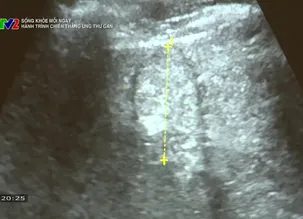 Sống khỏe mỗi ngày: Hành trình chiến thắng ung thư gan