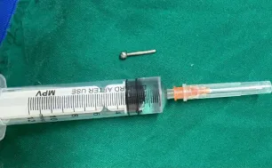Nhiều trường hợp nhập viện vì mắc dị vật tiêu hóa