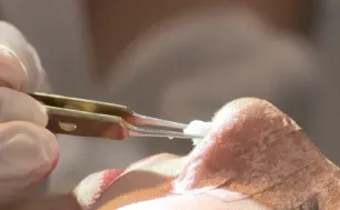 Cảnh báo biến chứng sau nâng mũi - Những dấu hiệu không thể bỏ qua