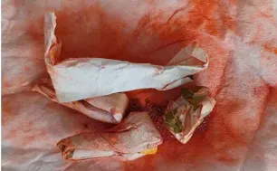 Ngộ độc chì sau khi bôi và uống "thuốc cam" 7 ngày