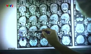 Sống khỏe mỗi ngày: Bước tiến mới trong phẫu thuật u não