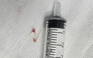 Bé 16 tháng nhập viện vì xương cá lọt vào đường thở