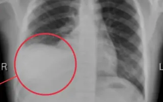 Cảnh báo tràn dịch màng phổi ở trẻ: Nguy hiểm nếu chậm phát hiện