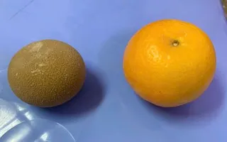 Lấy sỏi bàng quang to như quả cam khỏi cơ thể người đàn ông 69 tuổi