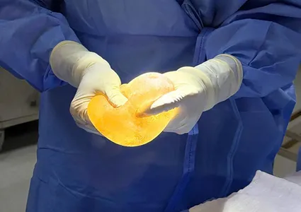 A rare case of bilateral breast implants with different implant types