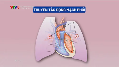 BỆNH VIỆN ON AIR_ Thuyên tắc phổi