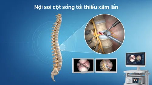 Nội soi cột sống thế hệ mới: Đột phá đổi thay cuộc sống người bệnh 