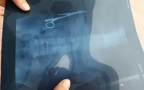 Phẫu thuật cho bệnh nhân bị bác sĩ bỏ quên kéo trong bụng 18 năm