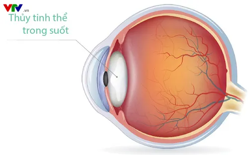 Chất lượng cuộc sống (16h15, 10/9/2017): "Wit - Bệnh đục thủy tinh thể - Bệnh không chỉ ở người già.