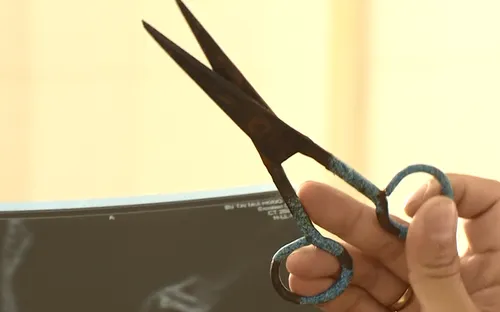 Phẫu thuật thành công cho bé trai bị kéo đâm xuyên qua tai