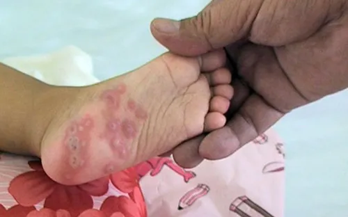 Số ca bệnh tay chân miệng ở Tây Nguyên tăng cao