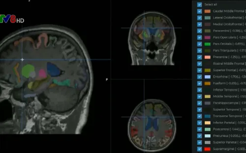 Hàn Quốc phát triển công nghệ chẩn đoán Alzheimer