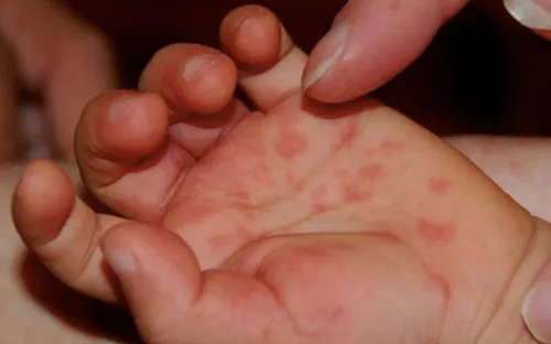 Bình Định xuất hiện nhiều ca sốt xuất huyết và tay chân miệng mới