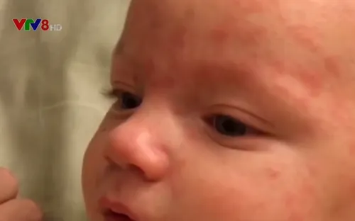 Tiêu điểm: Dịch sởi chết người bùng phát mạnh tại châu Âu và châu Á