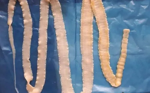 Sán lợn và cuộc "chu du" đáng sợ trong cơ thể con người