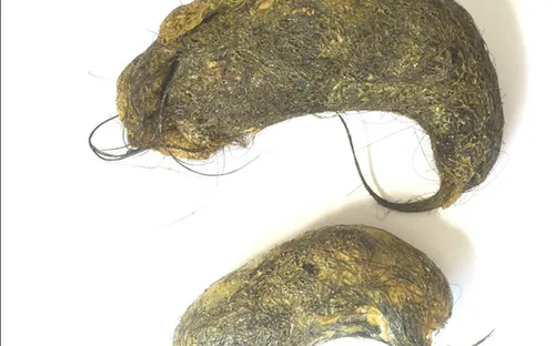 Phẫu thuật thành công 2 khối u tóc cho bệnh nhi 7 tuổi