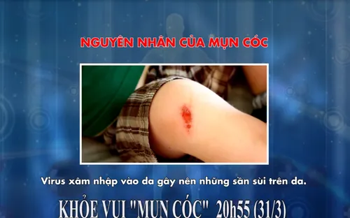 Khỏe Vui: Bệnh "mụn cóc" (20h55 thứ Bảy, 31/3)