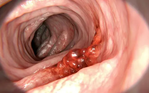 4 dấu hiệu cảnh báo ung thư đại trực tràng