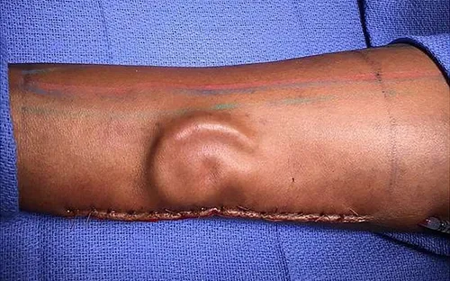Nuôi tai mới bên trong cánh tay của bệnh nhân