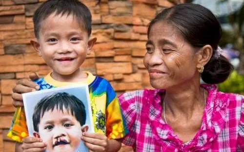 Phú Yên: Phẫu thuật nhân đạo cho bệnh nhân dị tật bẩm sinh