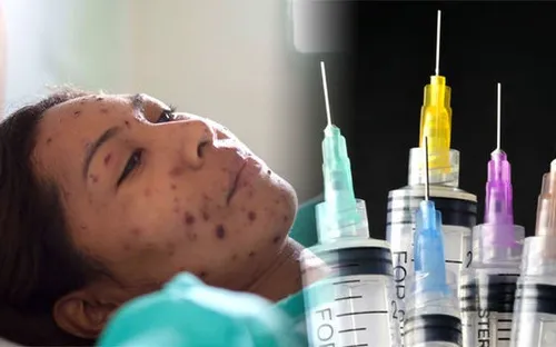 Dịch sởi bùng phát ở châu Âu do không tiêm phòng