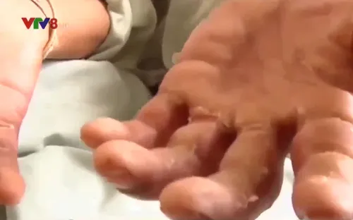 Quảng Ngãi gia tăng bệnh nhân bị bệnh dày sừng lòng bàn tay