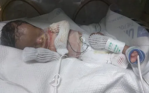 Mỹ: Em bé sơ sinh đầu tiên ở Texas được ghép da thành công