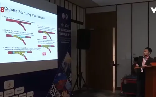 Can thiệp mạch - Giải pháp điều trị hiệu quả bệnh tim