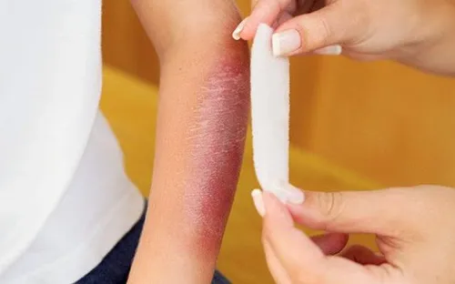 Xử trí vết bỏng sao cho đúng cách?