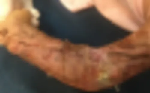 Vào công trường xây dựng chơi, bé trai bị máy trộn bê tông nghiền nát cánh tay