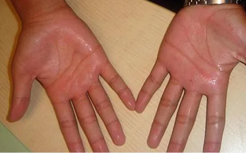 Cách ngăn chứng đổ mồ hôi tay