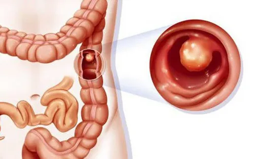 Dấu hiệu nhận biết ung thư đại tràng