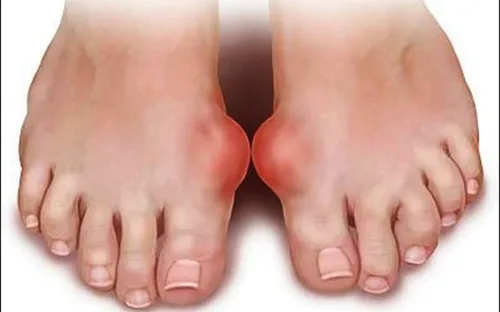 Chế độ ăn uống để điều trị bệnh Gout