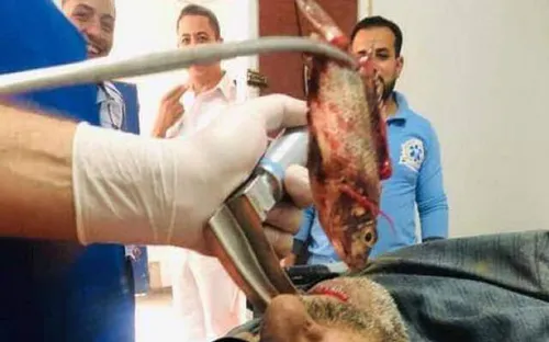 Suýt thiệt mạng vì bị mắc kẹt... con cá vẫn sống trong khí quản