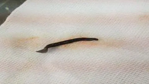 Gắp thành công đỉa dài 5cm trong mũi bệnh nhân